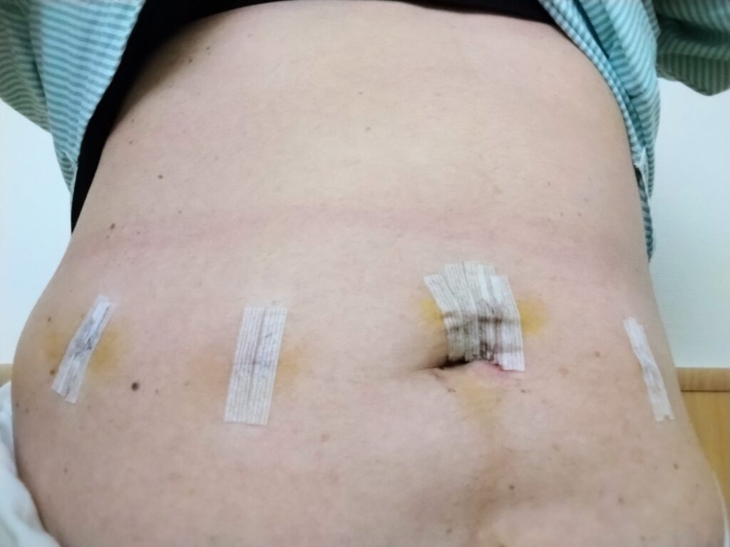 術後2日目の腹腔鏡手術の傷口（お腹の4か所の穴と保護テープ）の様子
